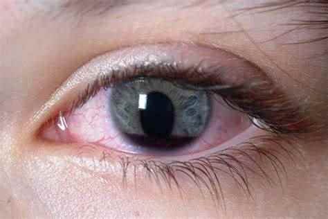 eye injury